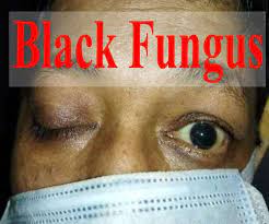 Black fungal disease