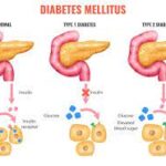 Illustration of diabetes types