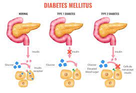 Illustration of diabetes types