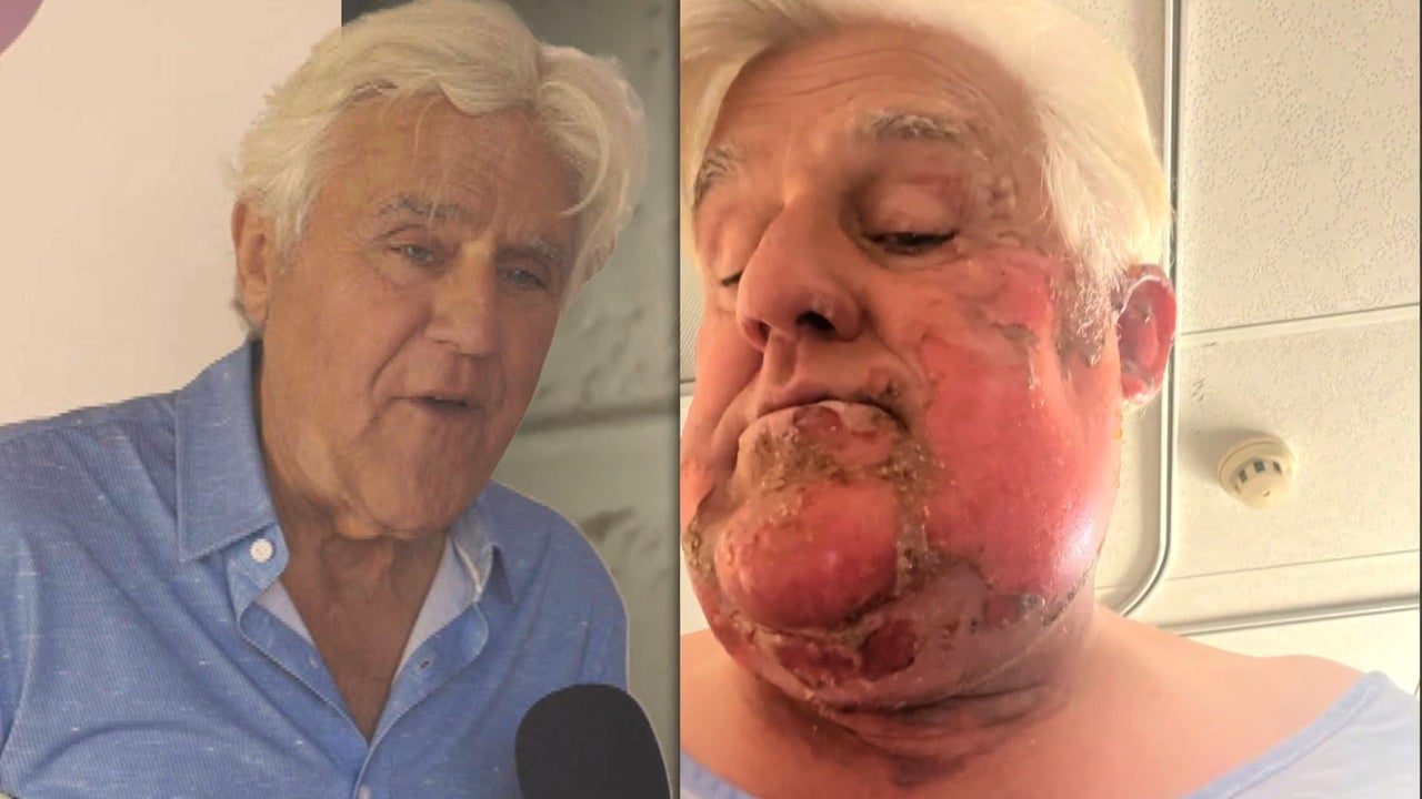 Jay Leno Shares Health Update 2 Years After Burn and Motorcycle Accidents