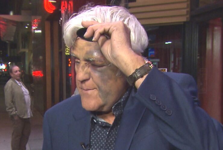 Jay Leno Seen With Badly Bruised Face, Broken Wrist and Eyepatch Following 60-Ft. Fall