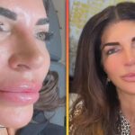 Teresa Giudice Films Herself Removing Lip Filler