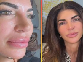 Teresa Giudice Films Herself Removing Lip Filler