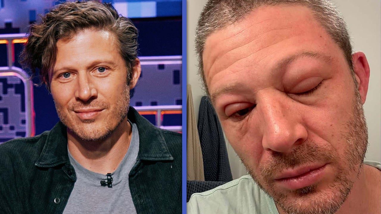 See ‘Criminal Minds: Evolution’ Star Zach Gilford’s Swollen Face After Medical Emergency