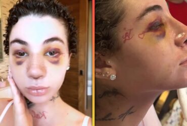 Bhad Bhabie Defends Getting Nose Job Amid Cancer Battle