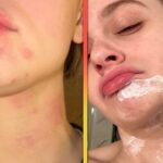 Joey King Reveals Burns All Over Her Face After Kitchen Accident