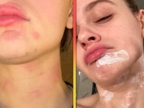 Joey King Reveals Burns All Over Her Face After Kitchen Accident