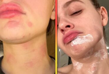 Joey King Reveals Burns All Over Her Face After Kitchen Accident