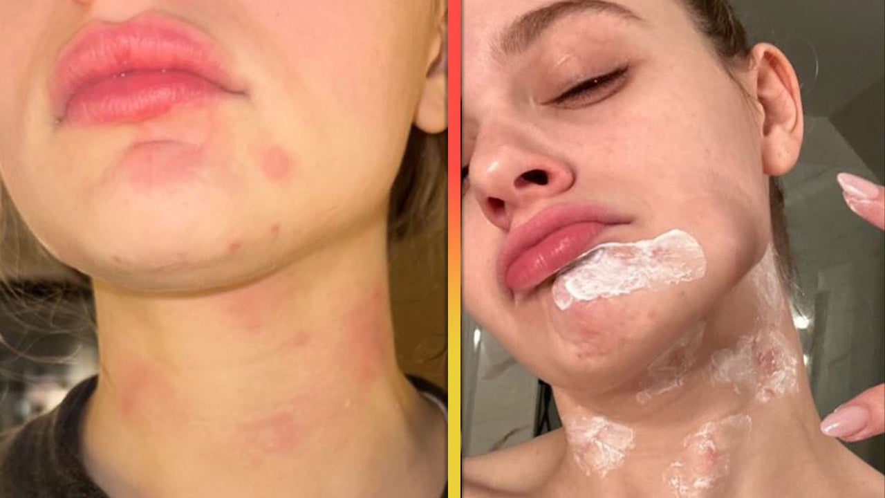 Joey King Reveals Burns All Over Her Face After Kitchen Accident