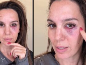 Christy Carlson Romano Gives Health Update After Being Shot in the Face