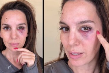 Christy Carlson Romano Gives Health Update After Being Shot in the Face