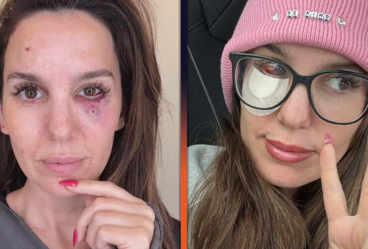 Christy Carlson Romano Reveals Gruesome Injury After She Was Shot in the Face