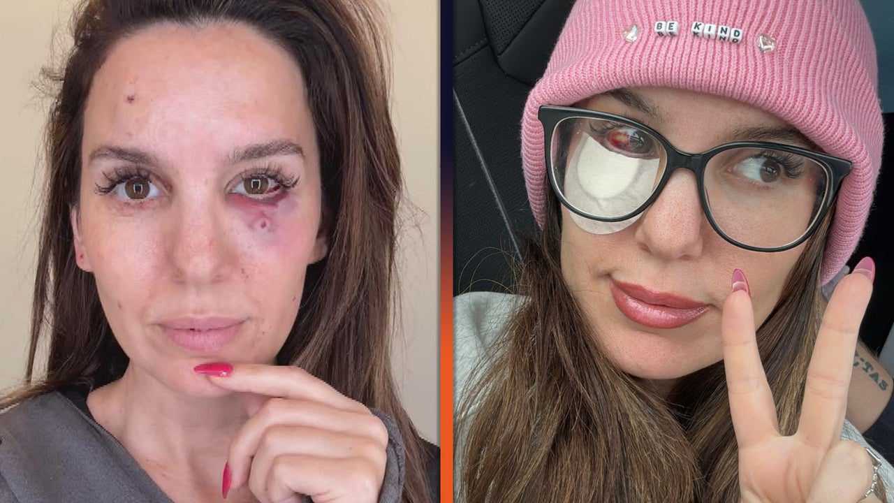 Christy Carlson Romano Reveals Gruesome Injury After She Was Shot in the Face